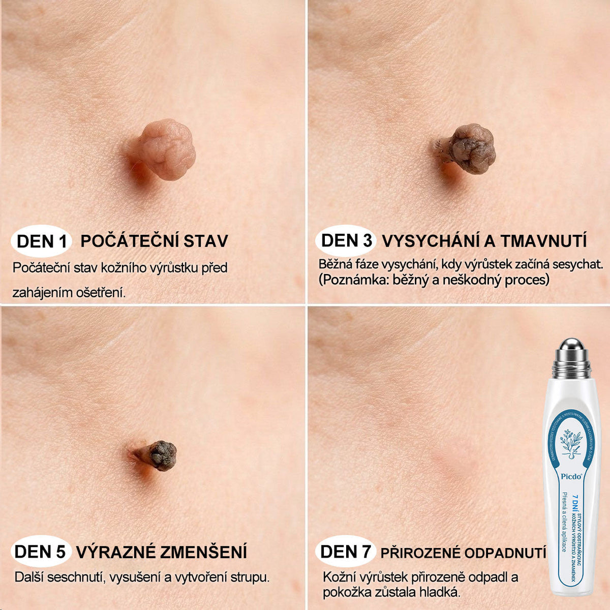 Oficiální značkový obchod |👩‍⚕️𝐏𝐢𝐜𝑑𝑜® 𝟩𝖽𝖾𝗻𝗻í 𝘰𝘥𝘴𝘵𝗋𝖺ň𝗈𝗏𝖺č 𝒔𝒌𝒗𝒓𝙣 𝙖 𝙥𝙞𝙜𝙢𝙚𝙣𝙩𝘰𝘷ý𝘤𝘩 𝘴𝘬𝖛𝖗𝖓 (Bezbolestný rollerball bez jizev)✨